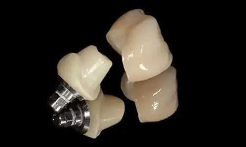 What Are the Advantages of Implant Cemented Crowns in Aesthetic Cases?